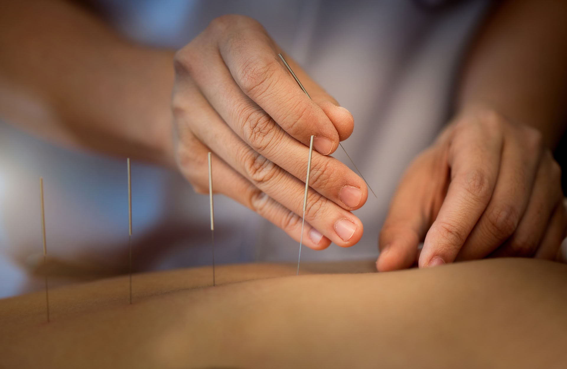 Akupunktur 1:1 Therapiesitzung in Ubud